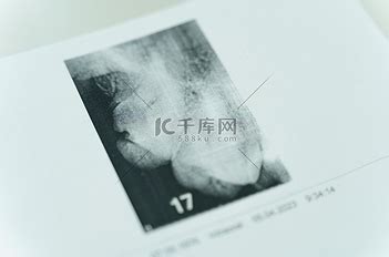 牙齿ct图图片