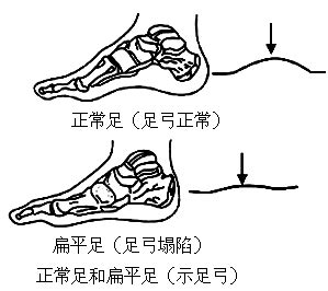 检查你的足弓发育情况. 足部的多块骨借关节和韧带紧密联结.使得足底形成凸向上方的弓形称为足弓.足弓具有弹性.可以缓冲行走时对身体所产生的振荡 ...