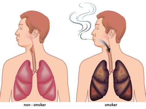 吸烟导致肺气肿的致病机制被发掘 - 爱爱医医学网