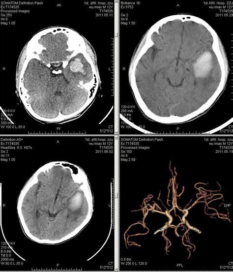 脑出血-名医解读CT-医学