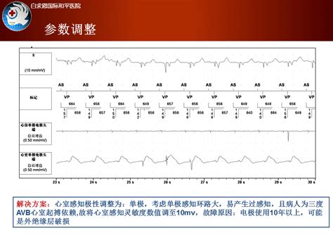 李洁：起搏器腔内电图的分析方法 课件 学术资源 心电生理 365医学网