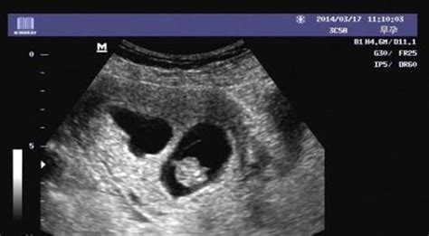 40天孕囊大小看男女对照表，这三个尺寸数据预测男孩超准_家庭医生在线