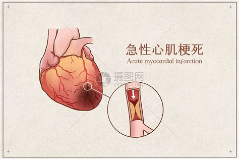 急性心肌梗死家庭急救 - 南京市第一医院