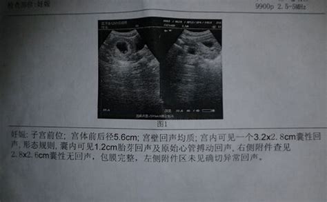 怀孕13周的B超图。大家看一下，胎儿正常吗？_百度宝宝知道-34周胎儿B超单，谁给看一下。谢谢！