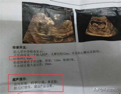 做一次nt要多少钱啊（怀孕的第一次检查很重要） - 上海资讯网