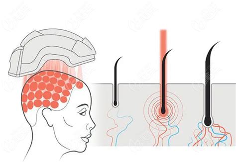 激光头皮理疗仪生发养发护发毛囊头发毛发头皮检测仪激光生发仪-阿里巴巴