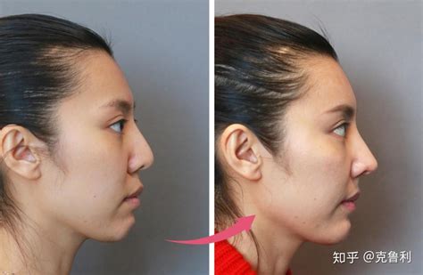 鼻子延长术前后图片,鼻子延长术前后对比,鼻子图片_大山谷图库