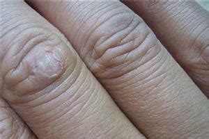 灰指甲初期的症状-灰指甲症状-复禾健康