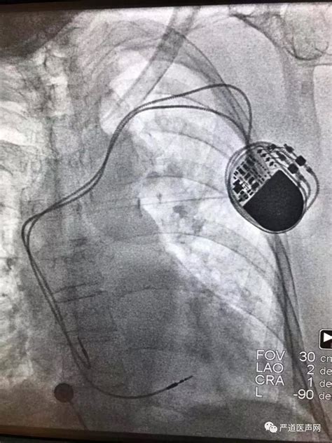 植入式心脏起搏器 ALTRUA系列 - 寰熙医疗