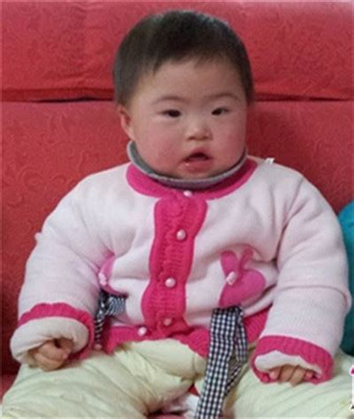 患有“唐氏综合征”的宝宝，面部特征很明显，婴儿阶段就能看出来_父母
