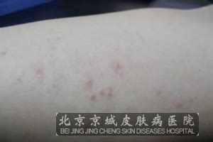 过敏性皮炎怎么引起的_过敏性皮炎_北京京城皮肤医院(北京医保定点机构)