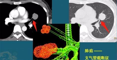 适用于肺癌的肿瘤标记物有哪些_陈滨海医生视频讲解肿瘤内科疾病-快速问医生