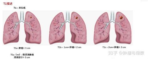 肺癌晚期死前症状图片-肺癌症状-复禾健康
