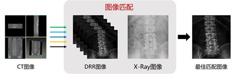 论文阅读-使用CNN从双平面X光片走向自动化3D脊柱重建以进行统计脊柱模型拟合_statistical spine model-CSDN博客