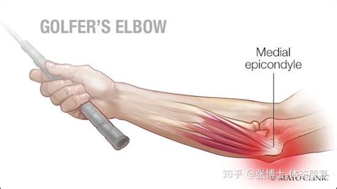 【运动康复科普】肘关节损伤的常见类型与急性处理方法 - 知乎