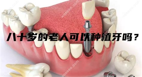 70岁老人适合种牙还是装假牙,全口镶牙、种植牙价格是多少,种植牙-8682赴韩整形网