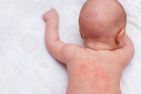 宝宝反复出现湿疹、过敏、干痒等各种皮肤病，元凶很有可能是它！ - 知乎