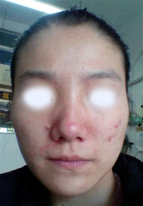 痈图片