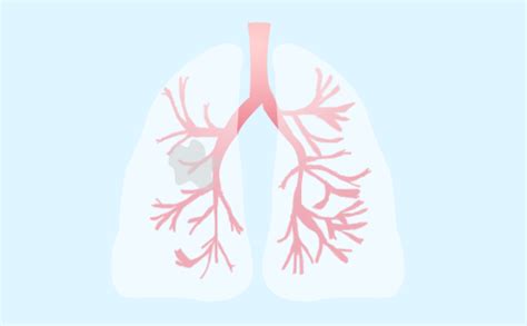 肺癌中晚期可以活多久？肺癌中晚期的典型症状是什么？ _肿瘤_医生在线