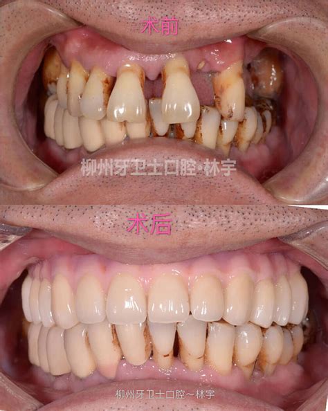 柳州牙卫士口腔种植牙案例 - 种植牙 - 大笨象APP_帮您找到优质的牙医