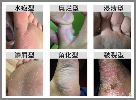 脚背湿疹图片