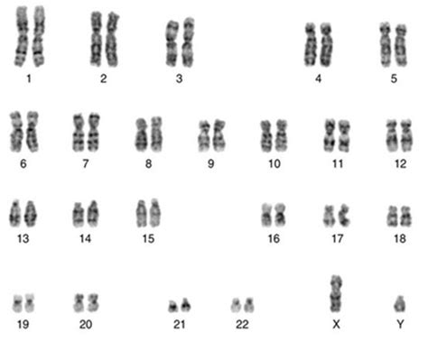 胚胎16号染色体三体的原因分析：真不一定是男方的问题_家庭医生在线