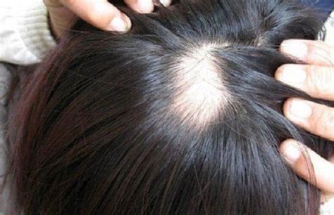 头皮毛囊炎反反复复发作，如何治疗？ - 知乎