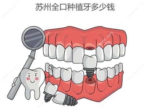 苏州种植牙医院靠谱排名前十榜单盘点 - 看牙记网