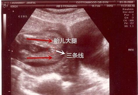 哪位专家能帮我看看这个B超图有可能是双胞胎吗，8周1天 谢谢 - 百度宝宝知道