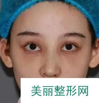 北京协和整形医院割双眼皮技术如何？费用贵不贵？_美嘉整形网(美学知识)