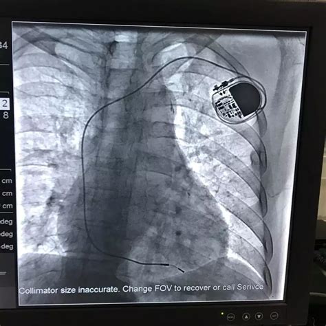 心脏起搏器迎来新时代，植入心脏起搏器（CRTD）后依然能做核磁共振 - 科室动态 - 湘南学院附属医院