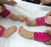 双胞胎女童患怪病 头颅畸形手脚像鸭蹼(图)_手机新浪网