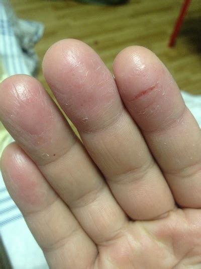 痒痒痒！姑娘手指长满小水泡还脱皮！医生：这症状夏天高发|手指|汗疱疹_新浪新闻