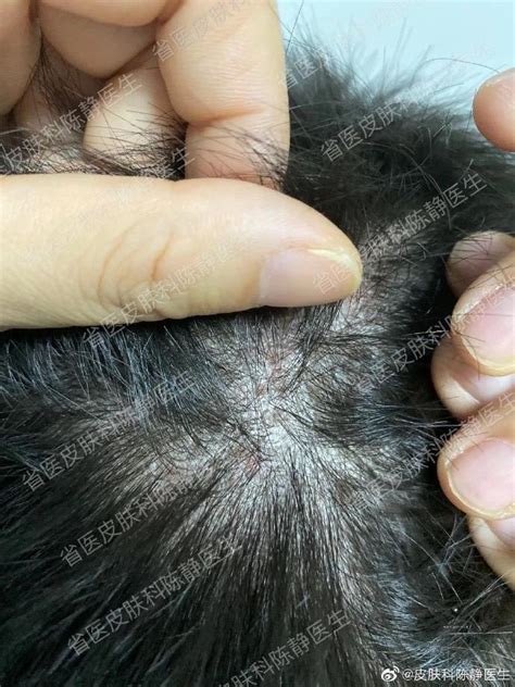 秃发性毛囊炎（bald folliculitis）的症状表现 - 皮肤病学 - 天山医学院