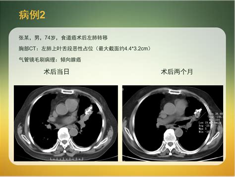 中国医科大学附属第一医院治疗肺癌专家_中国医科大学附属第一医院治疗肺癌哪个专家好_有来医生