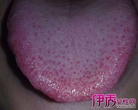 【舌头有红点】【图】舌头有红点怎么办 教你如何正确去辨别原因(3)_伊秀健康|yxlady.com