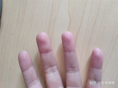 手指肿大竟查出肺癌？手的这些异样，可能是大病警告