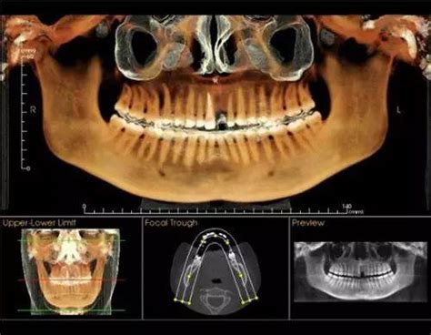 记录时代天使隐形牙套深覆合矫正牙齿过程 - 知乎