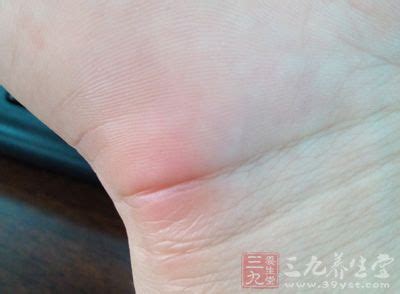 疮痈肿毒图片