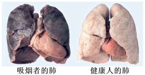 吸烟者的肺图片