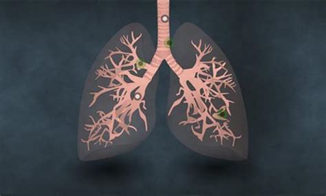 肺癌的早期症状和前兆有哪些？肺癌需要怎么确诊？-盛诺一家