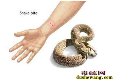 毒蛇咬伤 - 医学百科