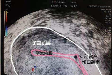 熊黛林剖腹产图片