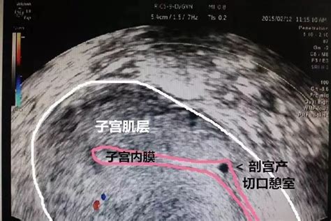 妇科手术器械阴式举宫器妇科举宫器杯式举宫器厂家-阿里巴巴