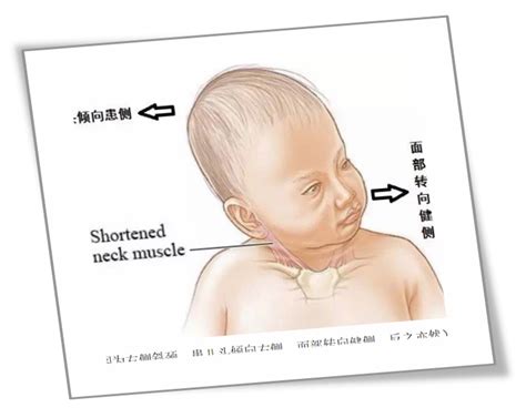 婴儿颈椎受损的表现（宝宝歪脖子）-幼儿百科-魔术铺