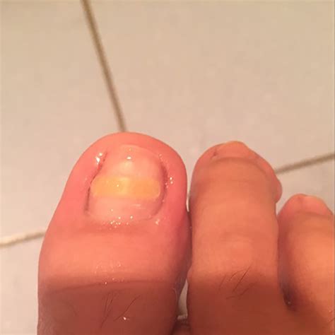 婴儿甲沟炎图片