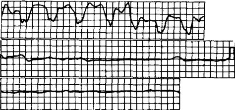 心电图图例分析：心房颤动、完全性右束支合并左前分支阻滞，左心室肥大-专业文章