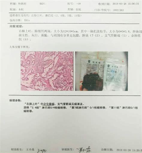 肺癌案例 | 左肺恶性肿瘤治疗病例分析_参莲