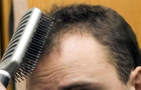 如果脱发怎么办怎么治疗再生发呢？ – 生发垂直网