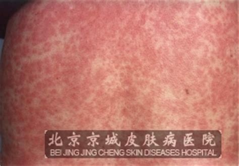 猩红热样药疹的症状_药疹_北京京城皮肤医院(北京医保定点机构)